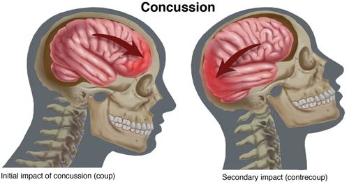 Concussion-Small